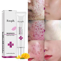 RtopR Mango Acne Repair Cream Face